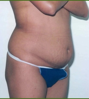 Real patient results in Newport Beach, CA Performed by Boris M. Ackerman MD