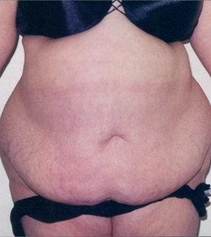 Real patient results in Newport Beach, CA Performed by Boris M. Ackerman MD
