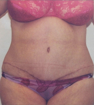 Real patient results in Newport Beach, CA Performed by Boris M. Ackerman MD